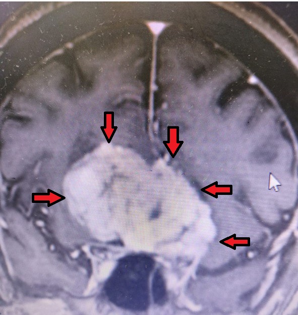 سيدة كويتية في العقد السادس ... 
عندها ورم سحائي كبير ...
تأجلت عمليتها ثلاث مرات ... لأسباب مختلفة
.
المرة الأولى ... التقييم أفاد أن الأعراض التي أدت لإكتشاف الورم, كانت بسبب جلطة خفيفة وأن الورم إكتشاف عرضي.
.
الثانية: طلب التخدير فحوصات للقلب ( تغيرات في التخطيط) 
.
الثالثة: