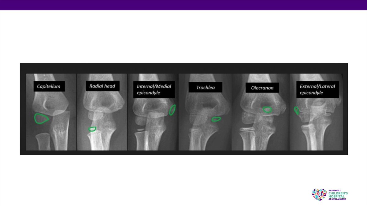 Today on #OVT watch as Mara Karamitopoulos, MD, of #NYU discusses #pediatric #xray assessment, addressing #orthopedic #trauma and #fractures topics.

@DrMaraK 
<a href="/nyulangoneortho/">NYU Langone Orthopedics</a> 
#OVTFridays #education #orthotwitter

bit.ly/3F5K4X2