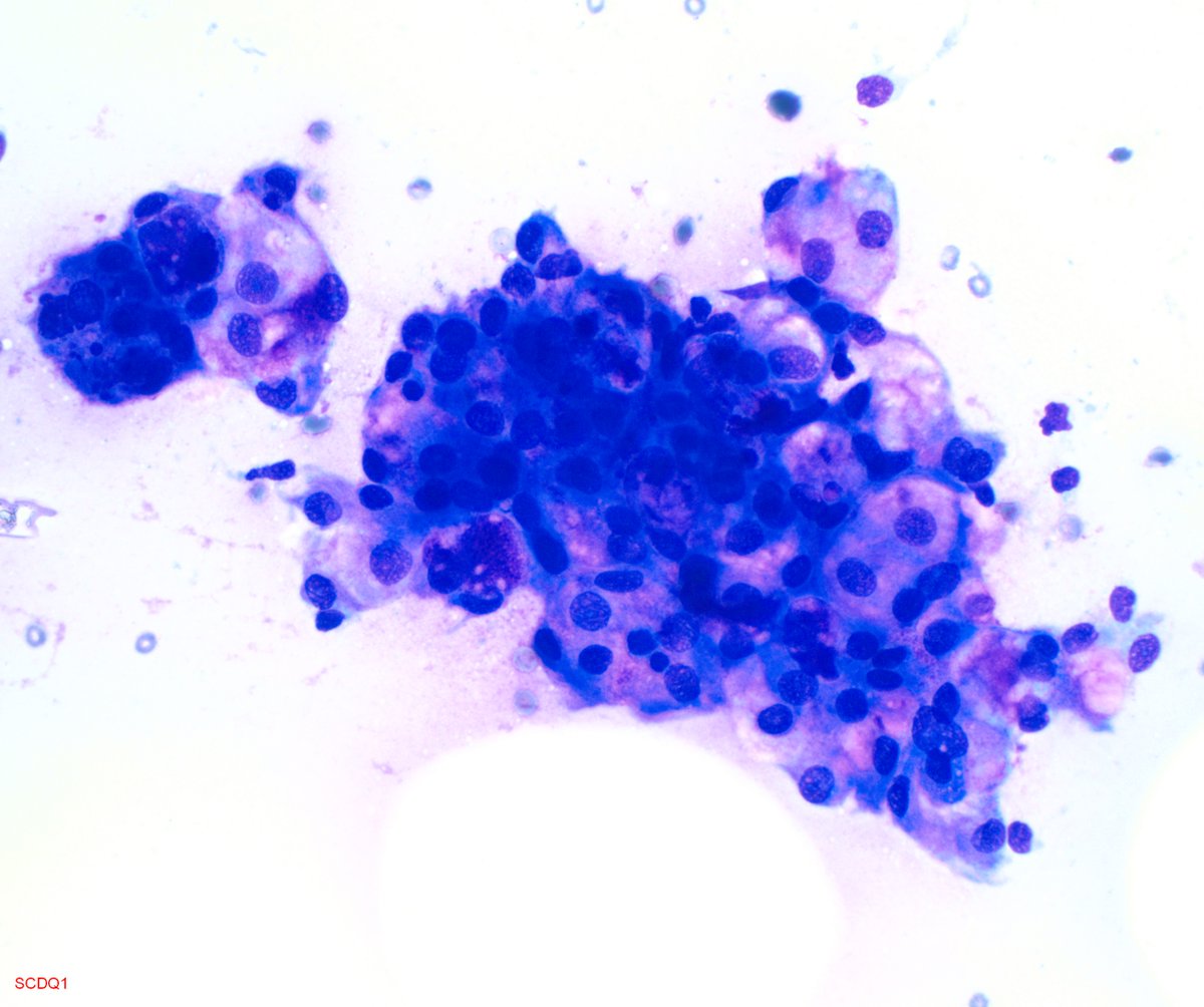 Cytology case of the week! 30M with 1cm parotid nodule, present for 1year. (Mammaglobin (+), S100 (+), GATA3(+), mucicarmine (-)) Which genetic aberrations will confirm the diagnosis? #pathresidents,<a href="/GWSMHS/">GW SMHS</a>,<a href="/GWPathology/">GWPathology</a>, #cytology,#cytopathology,#teachingcytopath,#PathTwitter