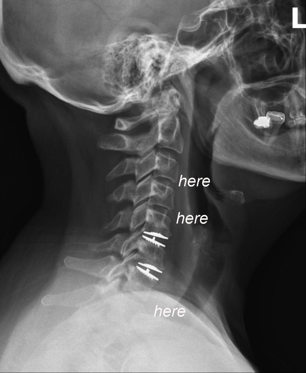 Luvumore_Minaj's tweet image. BARBZ and SIS @NICKIMINAJ 
This is a xray of my neck 
Where it says "HERE" is where they are going to put more plates and discs.
This will be happening in October after we see @NICKIMINAJ Sept 21st in #GagCityLA night 1 #Leg2 of #PinkFriday2WORLDTOURGagCity 
Please pray for me🙏