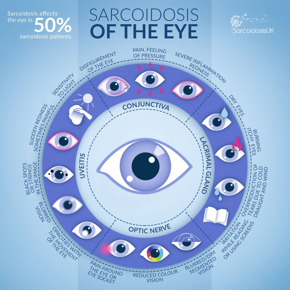 Around half of all sarcoidosis patients experience eye problems. It is important to detect eye diseases at an early stage. Proper monitoring and timely treatment can often prevent permanent damage.

Read more: buff.ly/3suW3ut