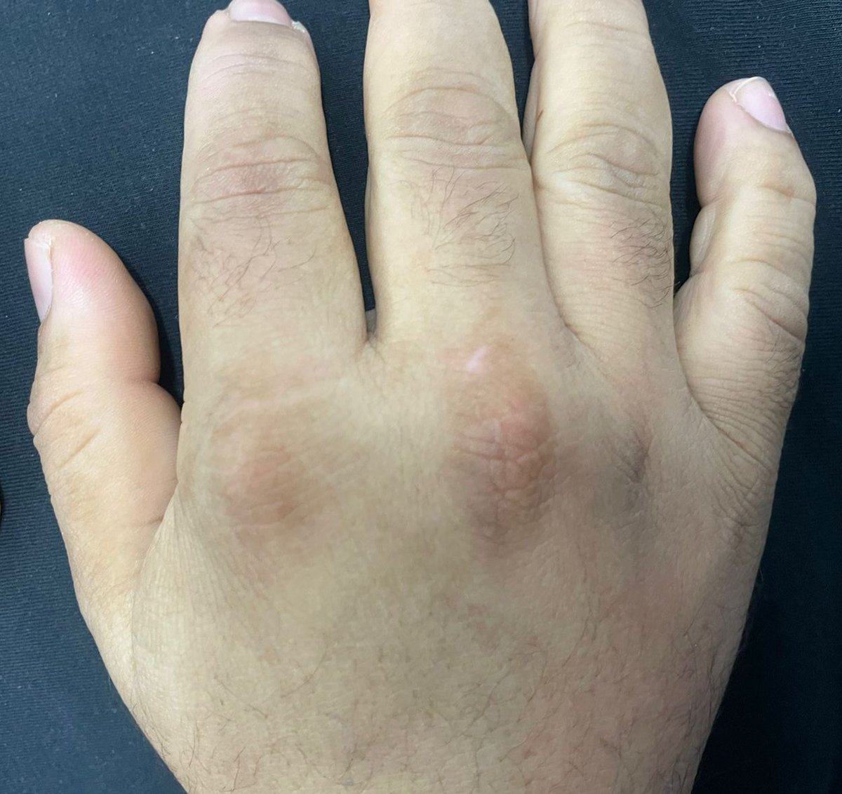 ConsejosReumato's tweet photo. Las pápulas de #Gottron son lesiones elevadas eritematosas o violáceas sobre el dorso de las IFP o #metacarpofalángicas como se ve en la foto. Se presentan en casos de #dermatomiositis. #Skin #dermatomyositis #rheumatology https://t.co/m0FfLhTSo7