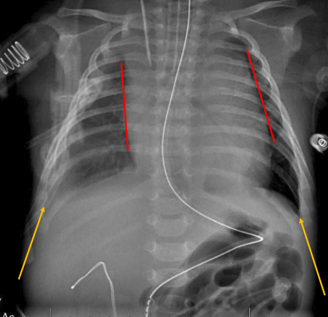 NICU_Musings's tweet photo. PSA FOR FAMILIES
Late onset Vitamin K deficient bleeding in a 6-week-old
Hemorrhages 🩸 in
🤯Thymus
🤯Pleural space
🤯Brain: intraventricular &amp; parenchymal
PREVENTABLE with IM Vitamin K after birth‼️
https://t.co/TxGGKLXfBZ
#neoTwitter https://t.co/CVboOfBVWS