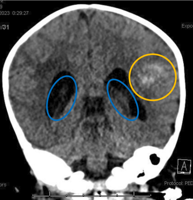 NICU_Musings's tweet photo. PSA FOR FAMILIES
Late onset Vitamin K deficient bleeding in a 6-week-old
Hemorrhages 🩸 in
🤯Thymus
🤯Pleural space
🤯Brain: intraventricular &amp; parenchymal
PREVENTABLE with IM Vitamin K after birth‼️
https://t.co/TxGGKLXfBZ
#neoTwitter https://t.co/CVboOfBVWS