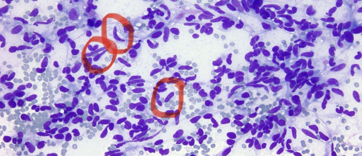 Sanjay Mukhopadhyay (@smlungpathguy) on Twitter photo <a href="/a_walk_home/">Priti Agarwal, MD, MHS</a> <a href="/ariella8/">Celina Stayerman MD</a> <a href="/ayat_ghazy/">Ayat Ghazy</a> <a href="/V_Masatkar/">Vaishali Masatkar, MD</a> <a href="/baatsebat/">baatseba</a> @GermHunterMD 17.
Lung neuroendocrine tumor tip for PGY1s: carcinoid tumors can have elongated nuclei and look like a spindle cell tumor
(This stain is a Diff Quik, used in cytology) <a href="/a_walk_home/">Priti Agarwal, MD, MHS</a> <a href="/ariella8/">Celina Stayerman MD</a> <a href="/ayat_ghazy/">Ayat Ghazy</a> <a href="/V_Masatkar/">Vaishali Masatkar, MD</a> <a href="/baatsebat/">baatseba</a> @GermHunterMD 17.
Lung neuroendocrine tumor tip for PGY1s: carcinoid tumors can have elongated nuclei and look like a spindle cell tumor
(This stain is a Diff Quik, used in cytology)