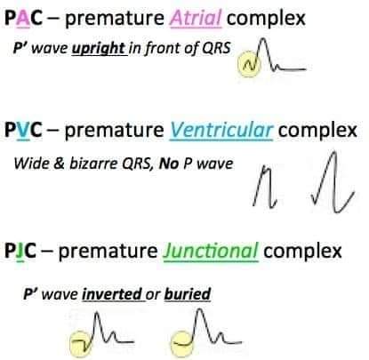 ZHeart11768530's tweet photo. 🔴 ECG Basics : Premature Complexes
#EKG #Multifocal #ECG #Cardiology #MAT #Atrial #Tachycardia #Diagnosis #comparison #electrocardiogram #Arrhythmias #ekg #clinical #ekg #diagnosis #tachycardia #cardiology #rhythm #Wandering #wap #pacemaker https://t.co/Qyr0AG13RQ
