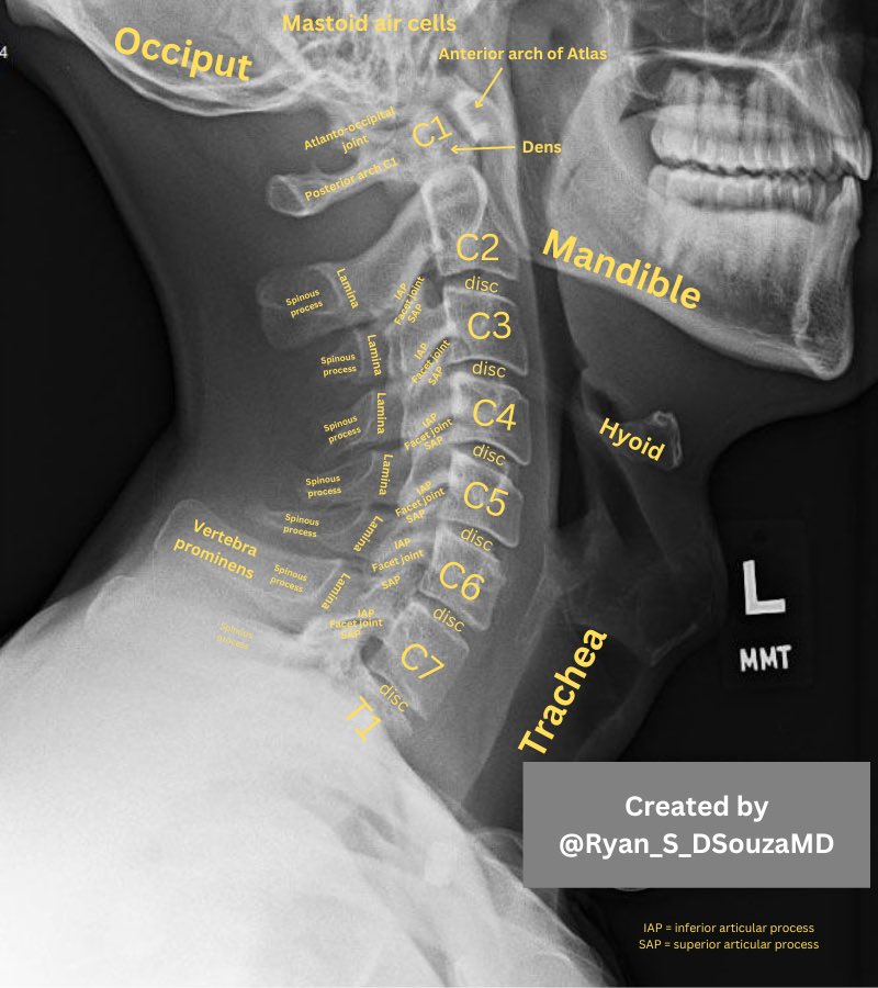 Ryan_S_DSouzaMD's tweet photo. Cervical spine landmarks to know on lateral x-ray📌 https://t.co/6e4rbORL9v