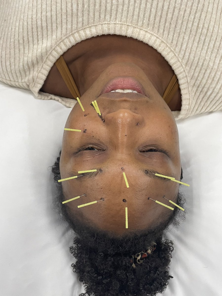 Managing headaches in Austin, TX. DN-1 in full swing. #physicaltherapy #dpt #spt #osteopractor #dryneedle <a href="/DrDunning/">James Dunning PhD, DPT, MSc</a> <a href="/osteopractor/">Osteopractic PT</a> <a href="/DrEscaloniPT/">James Escaloni</a> <a href="/PaulBliton/">Paul Bliton</a> <a href="/PatrickGorby/">Dr. Patrick Gorby, DPT</a>