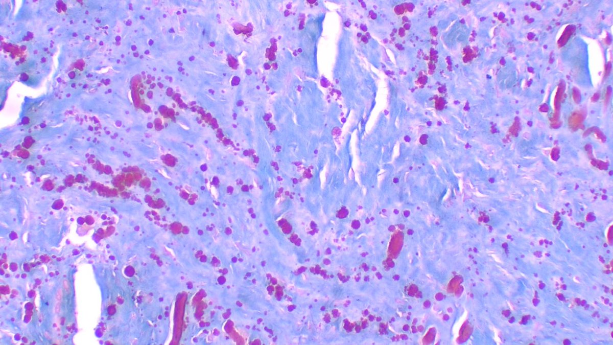 Int Soc Dermpath (@intsocdermpath) on Twitter photo #ISDP #Olympics
Spot diagnosis
Case 16 - <a href="/JCandidoXavier/">Jose Candido</a>
ELASTOFIBROMA
•Benign soft tissue tumor characterized by abnormal elastic fibres and fibroblasts
•Hypocellular tumor with fragmented and thickened to globular elastic fibres
#Pathology #path #dermatology #derm #ISDP #Olympics
Spot diagnosis
Case 16 - <a href="/JCandidoXavier/">Jose Candido</a>
ELASTOFIBROMA
•Benign soft tissue tumor characterized by abnormal elastic fibres and fibroblasts
•Hypocellular tumor with fragmented and thickened to globular elastic fibres
#Pathology #path #dermatology #derm