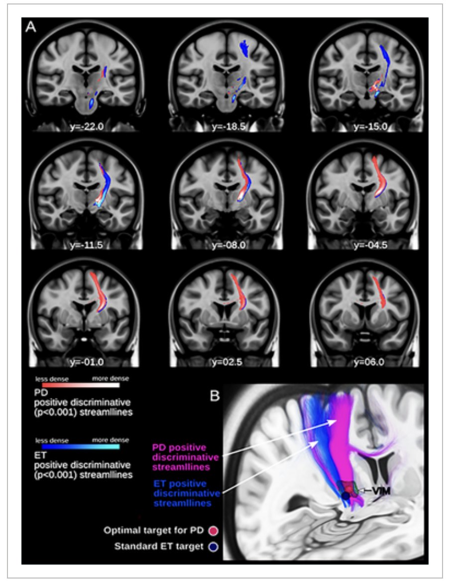 Where is the best thalamic target for focused ultrasound therapy in tremor dominant Parkinson's? Well of course use probabilistic refinement like Cheyuo, Lozano and colleagues did <a href="/UofT/">University of Toronto</a> <a href="/MDJ_Journal/">Movement Disorders Journal</a> to demonstrate that the most effective MRgFUS thalamotomy target for tremor