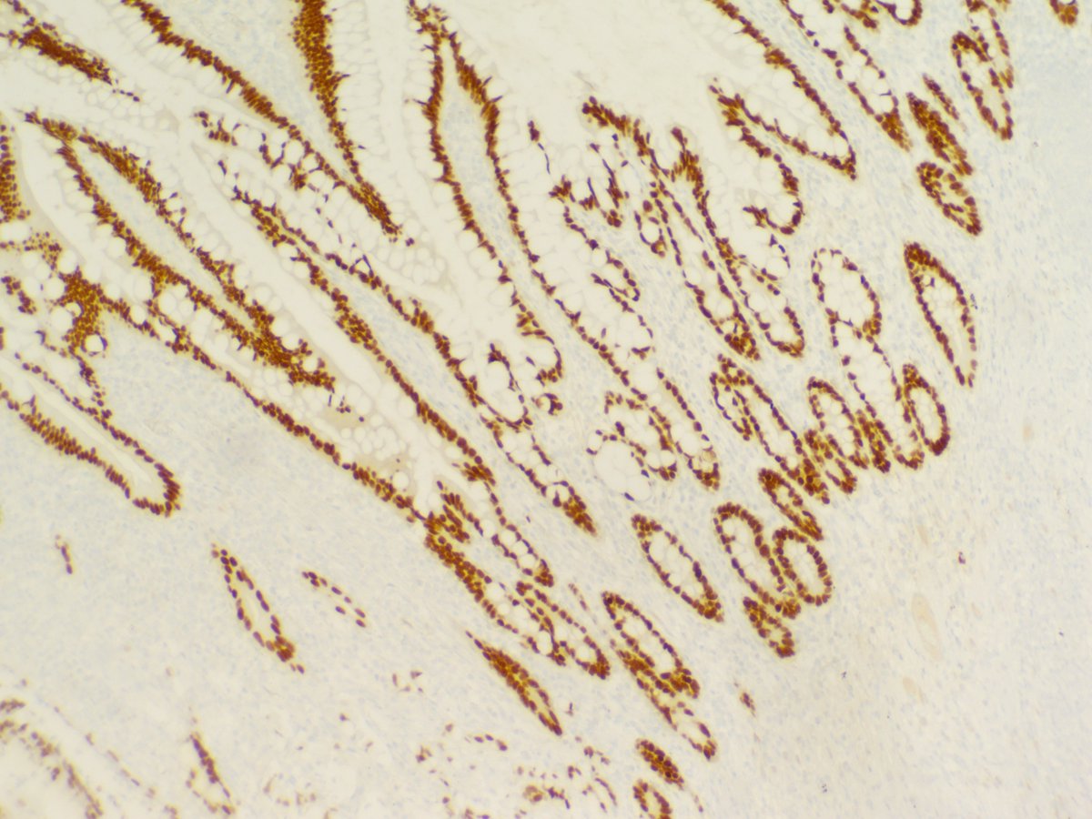Terminal ileum perforation in a 45 y.o F with a history of stage 3 cervical cancer. Grossly, a mucinous red-brown mass surrounds the perforation. Positive for CK7, CK20, &amp; CDX2, patchy positive for p16, &amp; negative for PAX8, synaptophysin, &amp; chromogranin. Diagnosis?