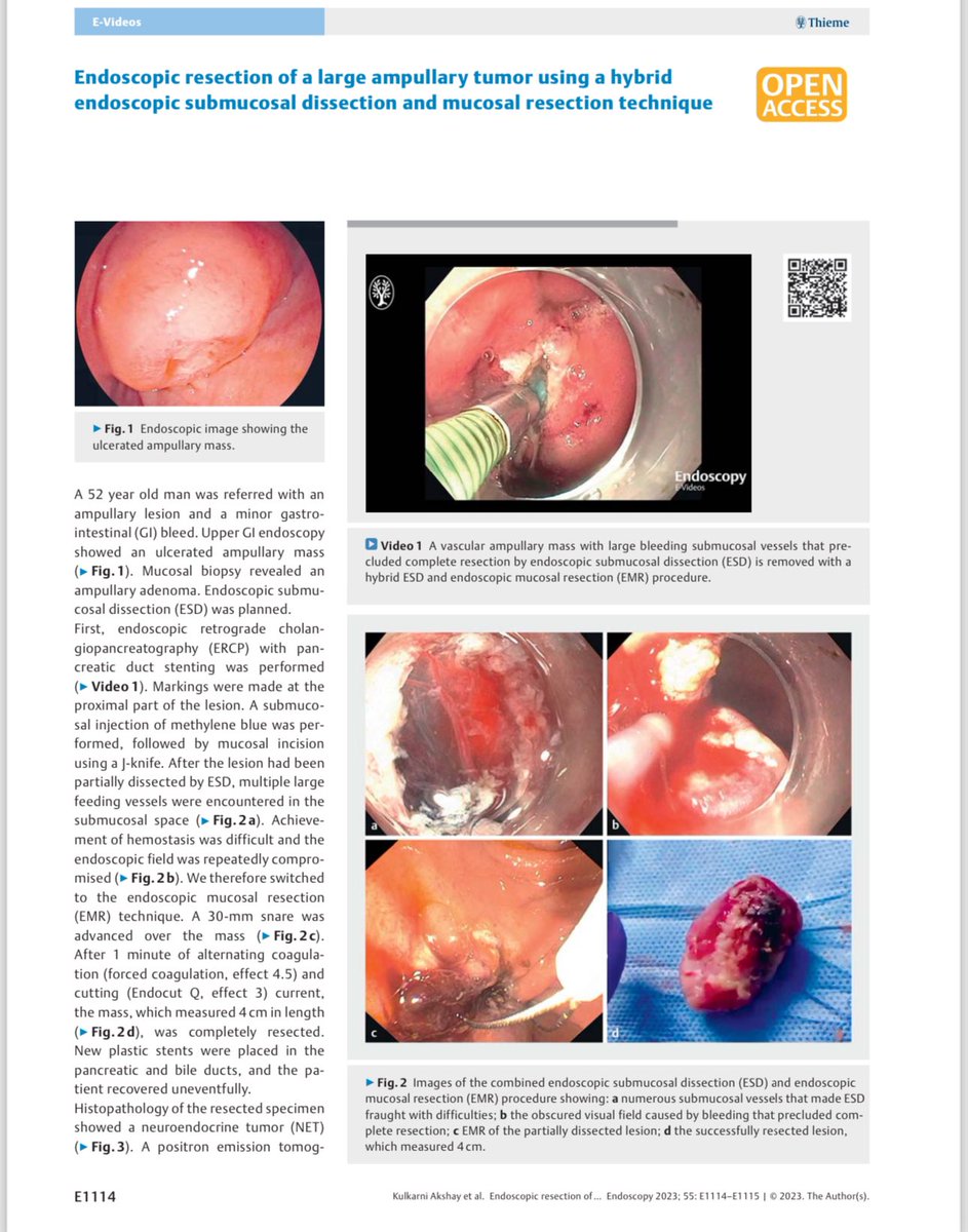 saurabhmukewar's tweet image. Large ampullary NET removed with hybrid ESD EMR..

#ESD #ampullarytumor #ampullectomy