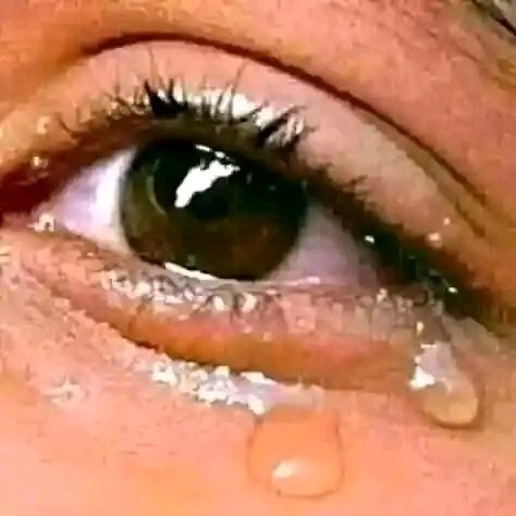 RAnwuna's tweet photo. @LawrenceOkoroPG Eye red😥 https://t.co/edca6CIBxE