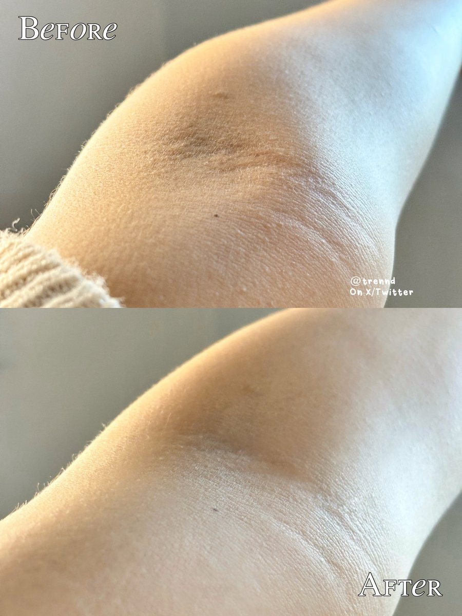 trennd's tweet photo. Siapa sangka kulit kering beserta bump kecil di lipatan lenganku berkurang 🥰🫵🏻

Jadi one of my fav body exfoliator dan hasilnya nampol bangettt ✨

Before &amp; After:                                The product: https://t.co/kCHPhbw3Co