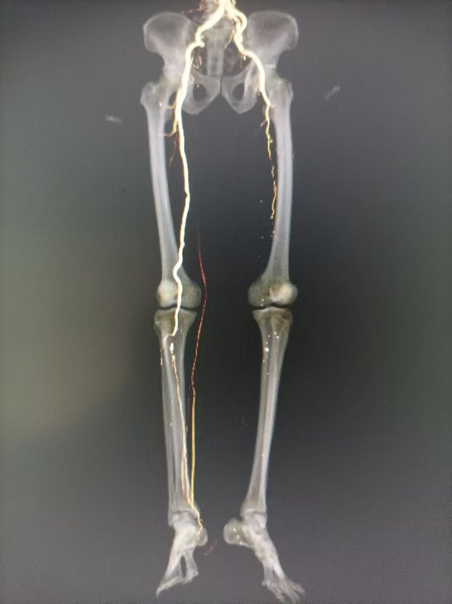 anjun22549232's tweet photo. @PennLimbSalvage We recently also have met a Pt with limb ASO, and also was told amputation in high level of    Lt. limb in several hospitals. Here in our Dept. Lt femoral to popliteal artery embolectomy with open and cath.. has done https://t.co/xgYeQB9Wb3