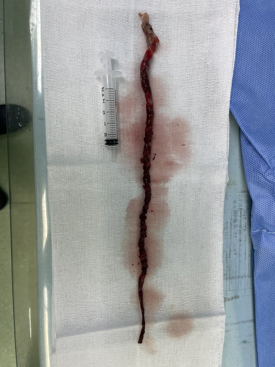 anjun22549232's tweet photo. @PennLimbSalvage We recently also have met a Pt with limb ASO, and also was told amputation in high level of    Lt. limb in several hospitals. Here in our Dept. Lt femoral to popliteal artery embolectomy with open and cath.. has done https://t.co/xgYeQB9Wb3