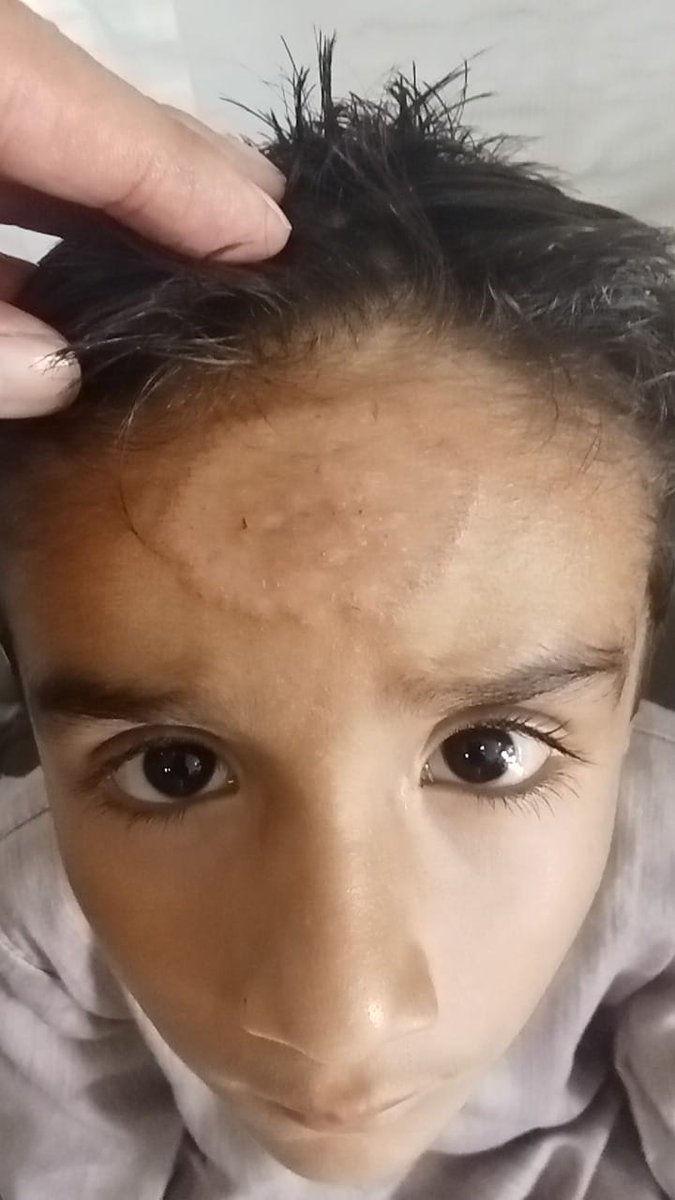 mimalkera's tweet photo. Tinea 
#MedTwitter #dermatology #medicine https://t.co/hFq49E4ZmP