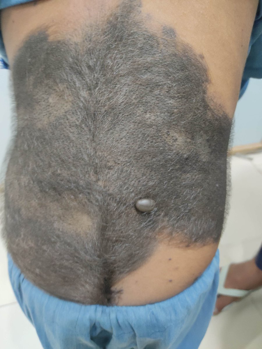 mimalkera's tweet photo. Hypertrichosis..
#MedTwitter #dermacases #drmalkera #medicine https://t.co/DHSoC7KJZ4