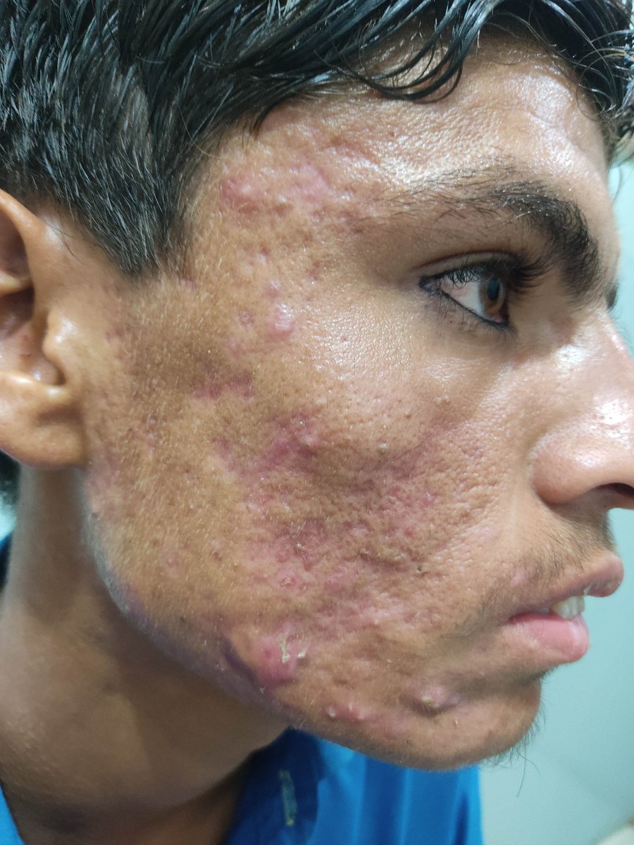 mimalkera's tweet photo. Nodulocystic Acne ( before / after 1 month use of isotretinoin) https://t.co/k2fLjV688X