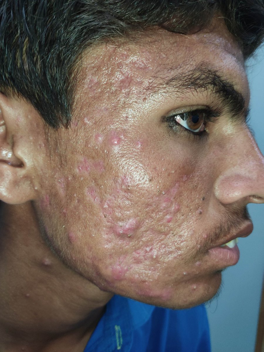 mimalkera's tweet photo. Nodulocystic Acne ( before / after 1 month use of isotretinoin) https://t.co/k2fLjV688X