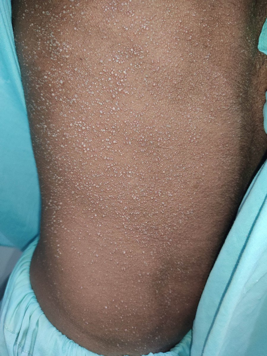 mimalkera's tweet photo. Miliaria 
#heatrash #MedTwitter #dermatology #medcases #drmalkera https://t.co/nqeFOJvfXF