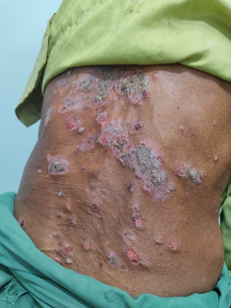 mimalkera's tweet photo. Psoriasis in 70 year old pateient
#psoriasis #MedTwitter #medcases #medicine #drmalkera https://t.co/KhDFumRFZ3