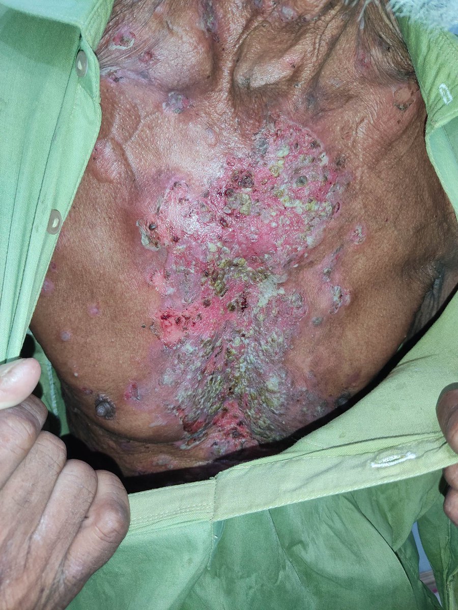 mimalkera's tweet photo. Psoriasis in 70 year old pateient
#psoriasis #MedTwitter #medcases #medicine #drmalkera https://t.co/KhDFumRFZ3