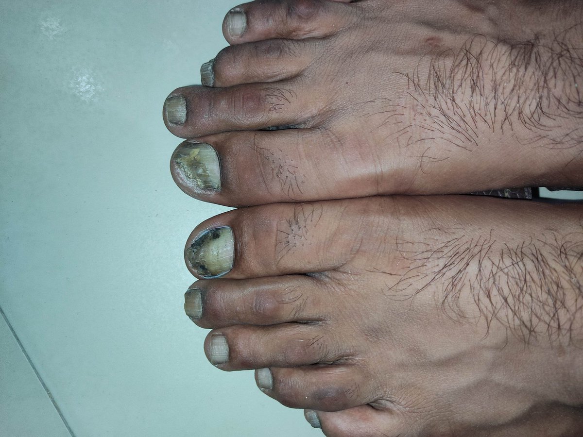 mimalkera's tweet photo. Onychomycosis 
#MedTwitter #nails #medical #drmalkera https://t.co/HE8Z9fvKqO