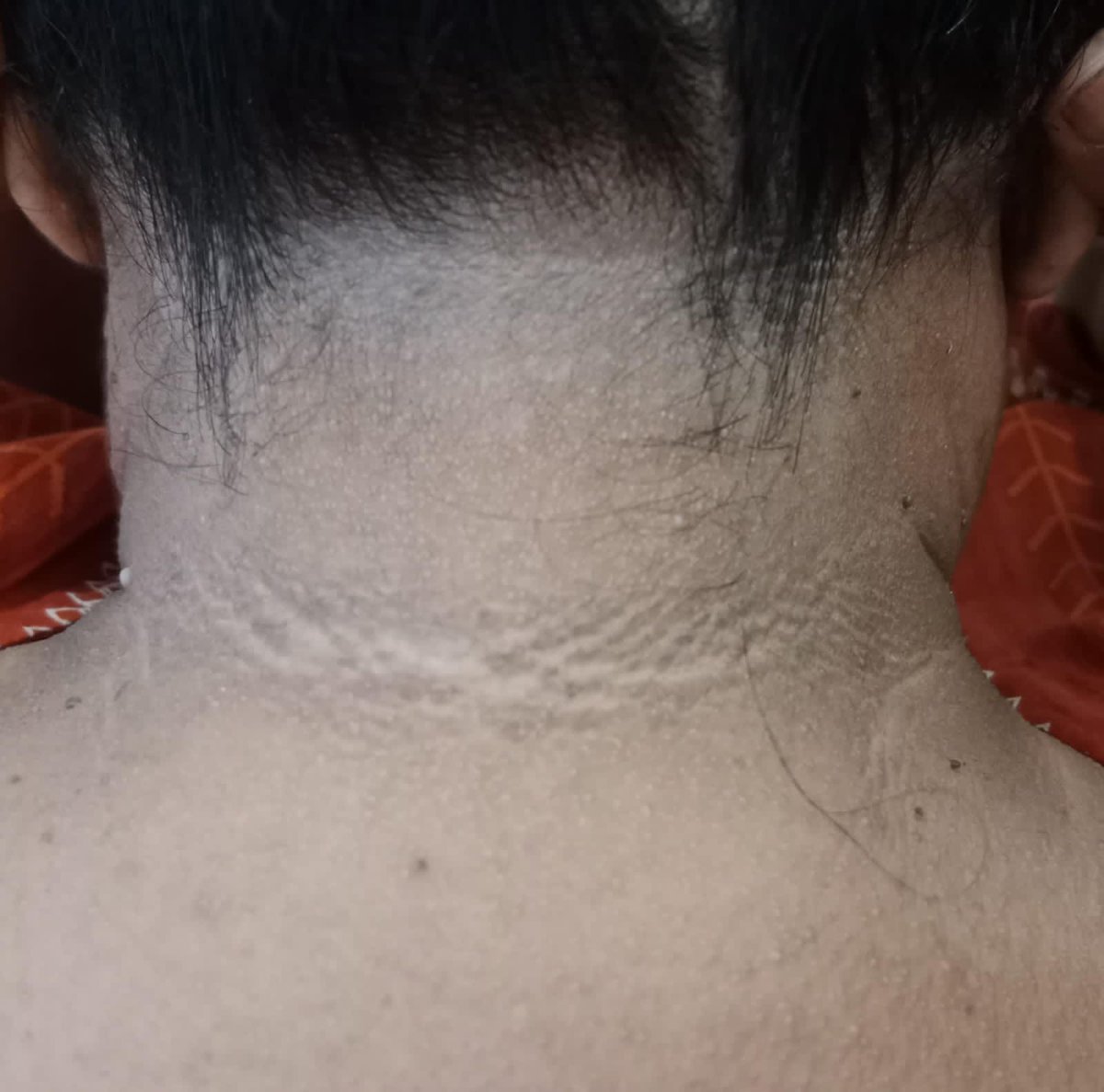 mimalkera's tweet photo. Acanthosis nigricanas 
#insulin #MedTwitter #Medical #doctor #drmalkera https://t.co/uMtic2Mmi8