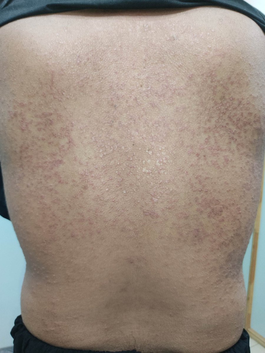 mimalkera's tweet photo. Heat Rash / sweat rash / miliaria / prickly heat
#MedTwitter #derma #doctor #drmalkera https://t.co/NU9gBXjBvV