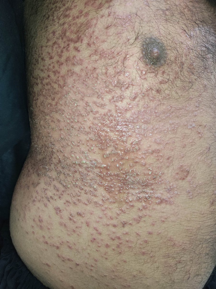 mimalkera's tweet photo. Heat Rash / sweat rash / miliaria / prickly heat
#MedTwitter #derma #doctor #drmalkera https://t.co/NU9gBXjBvV