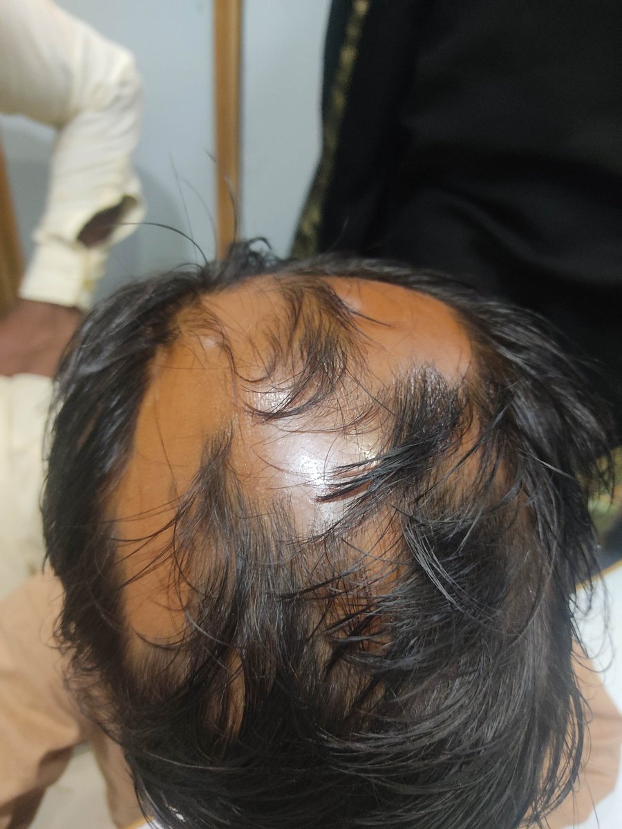 mimalkera's tweet photo. Alopecia
#MedTwitter #medical #derma #alopecia #drmalkera https://t.co/dbxBSij7wn