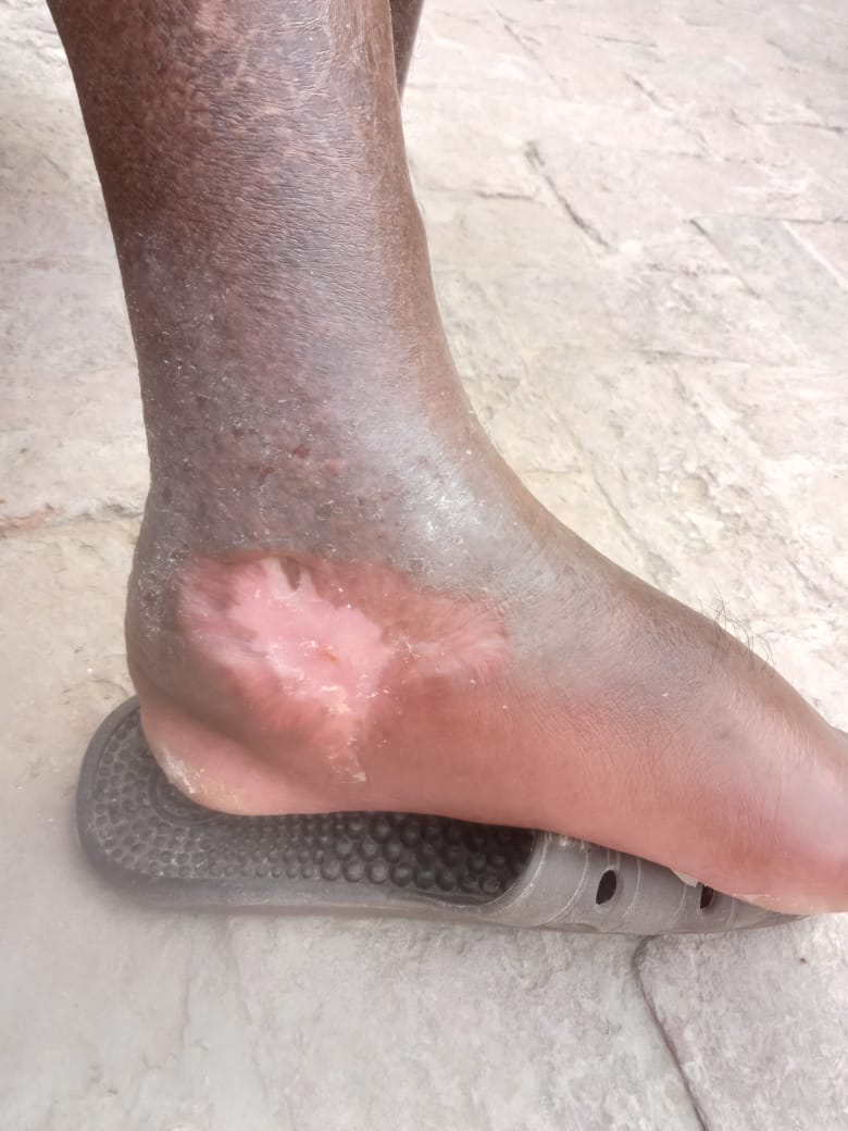 mimalkera's tweet photo. Dx  ??
Cellulitis with stasis dermatitis 

#MedTwitter #derma #skin #drmalkera https://t.co/PMhqnvRMpt