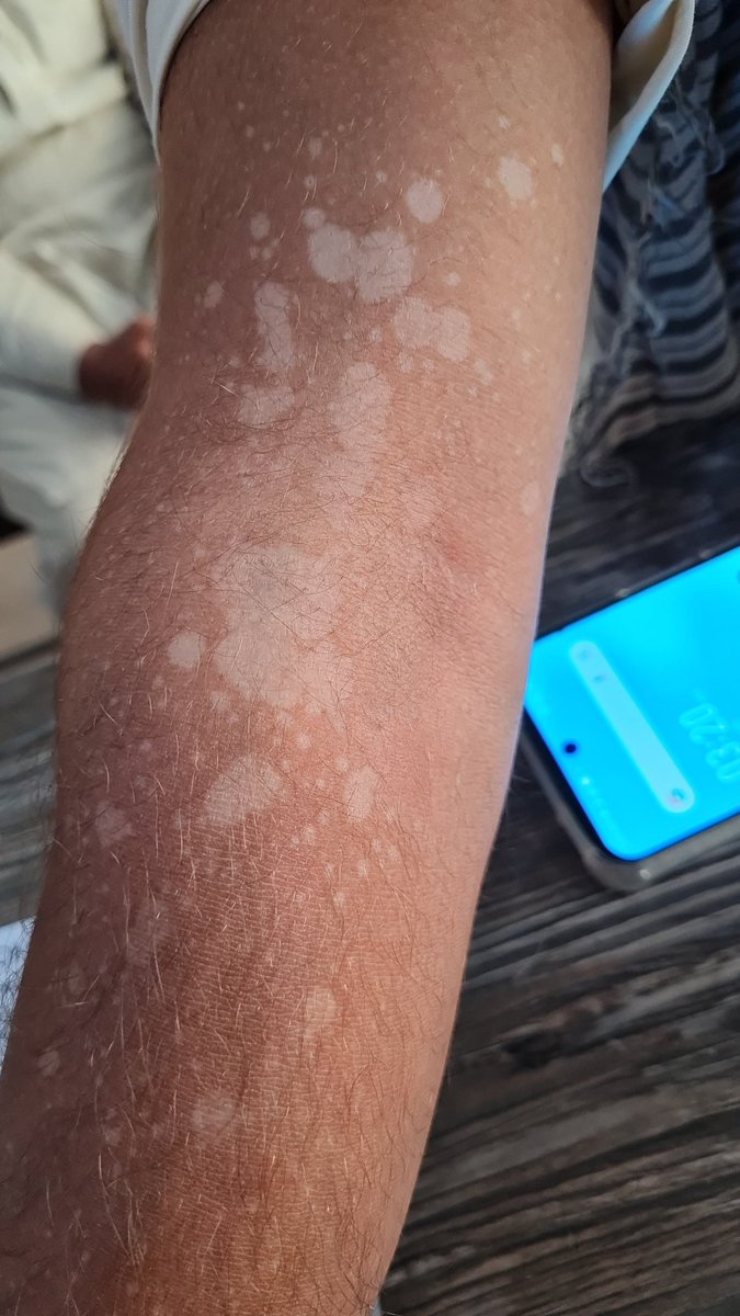 mimalkera's tweet photo. Tinea versicolor

#MedTwitter #medical #derma #skin #drmalkera https://t.co/9FmtyTzfLO