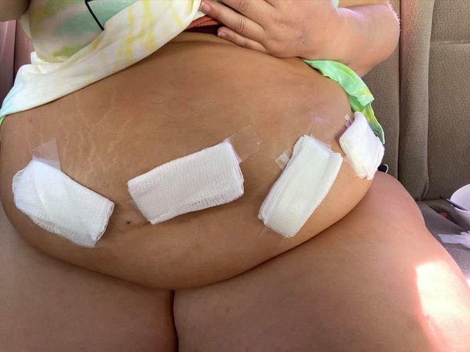 Today 4 years ago I went through a hysterectomy to remove everything due to Cervical C&aacute;ncer!  I remember