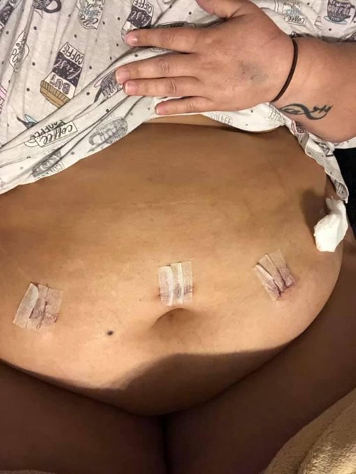 Today 4 years ago I went through a hysterectomy to remove everything due to Cervical C&aacute;ncer!  I remember