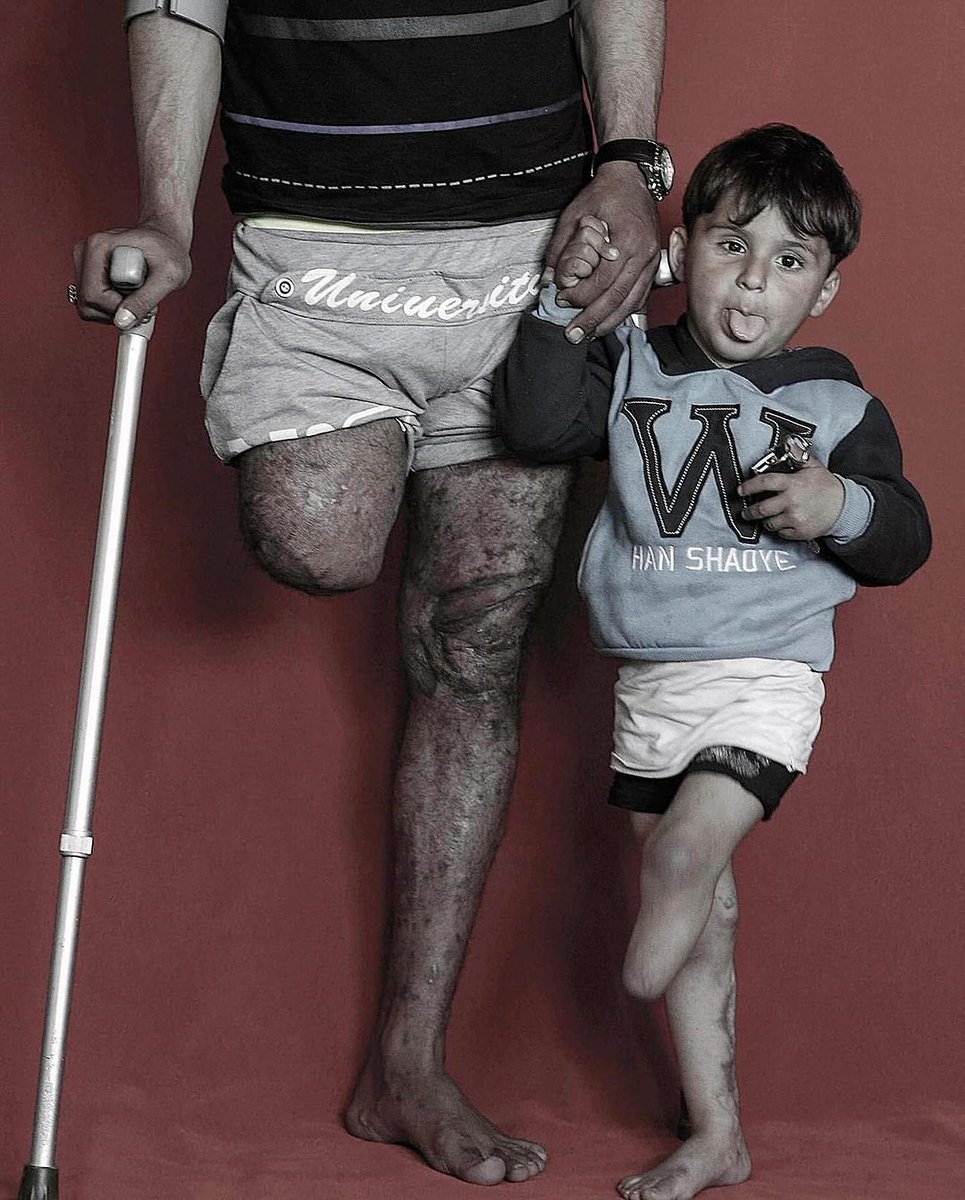 No Dia dos Pais do genocídio, famílias palestinas não têm nada a comemorar.

Pais enterram filhos. Filhos enterram pais. Famílias destruídas pelo projeto genocida de "israel" na Palestina. 

Algumas histórias no fio 🧶👇

1. Pai e filho mutilados por "israel" em Gaza.