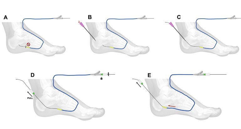 Marta Lobato (@marlobat) on Twitter photo Hot off the press!!!
BTA Antegrade Teleferic Technique: New Approach for BTA Revascularization in Challenging Cases of CLTI.
Extremely grateful to everyone involved.
<a href="/YsaAugust/">August Ysa</a> , Amaia Arruabarrena, Esther Martínez Aguilar, Juan Luis Fonseca and <a href="/vascularIR/">Lorenzo Patrone</a>
<a href="/Vascupedia_com/">Vascupedia</a> Hot off the press!!!
BTA Antegrade Teleferic Technique: New Approach for BTA Revascularization in Challenging Cases of CLTI.
Extremely grateful to everyone involved.
<a href="/YsaAugust/">August Ysa</a> , Amaia Arruabarrena, Esther Martínez Aguilar, Juan Luis Fonseca and <a href="/vascularIR/">Lorenzo Patrone</a>
<a href="/Vascupedia_com/">Vascupedia</a>
