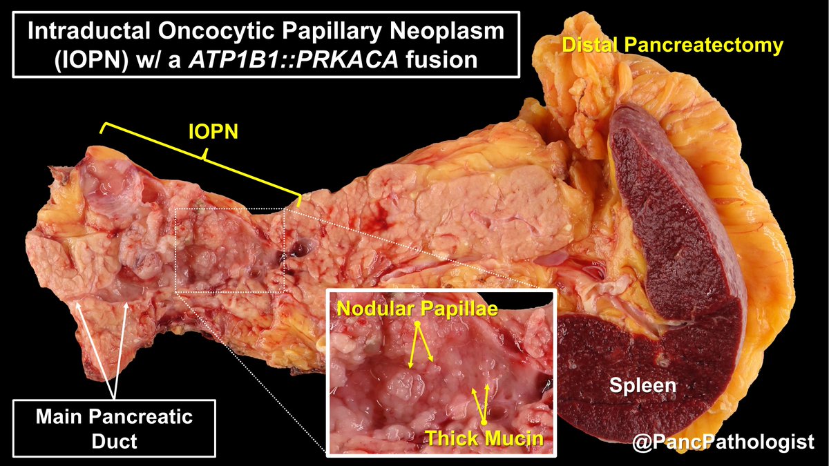 PancPathologist's tweet photo. Intraductal Oncocytic Papillary Neoplasm (IOPN), #HGD, of the main &amp; branch ducts in the #Pancreas. Interesting story, FNA in 2010 when 1.8 cm &amp; repeat testing found a PRKACA fusion. The patient was asked to f/u &amp; now 6.0 cm. #Pathology #GIPath #PancreaticCancer #PancreaticCyst https://t.co/omDmy58IY7