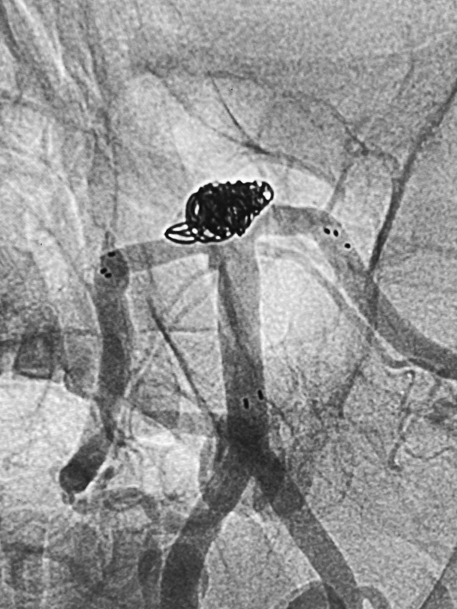 T-stent coiling for a ruptured wide-necked BA tip aneurysm.