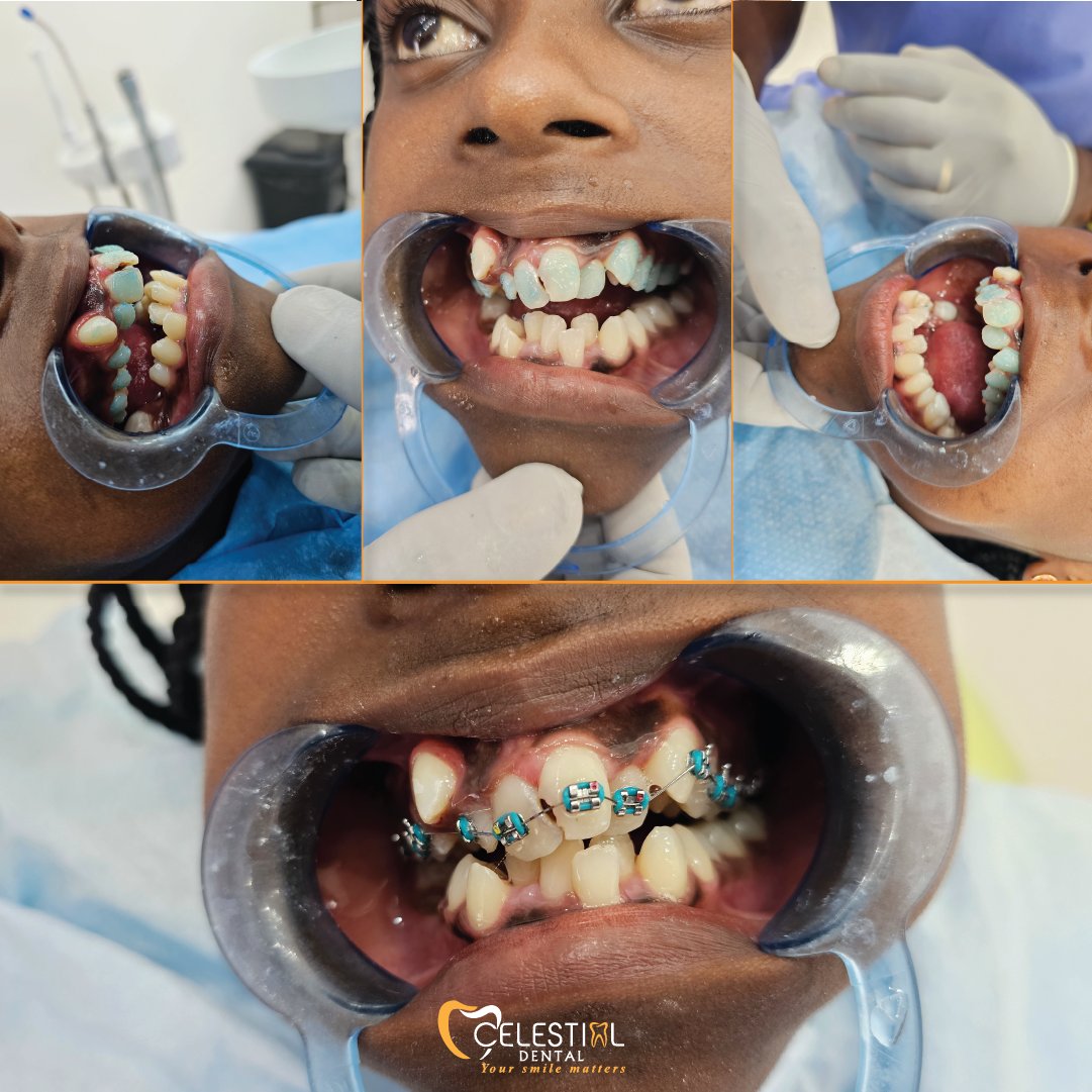 celestialdental's tweet image. Meet our recent patient, who’s starting her smile transformation! From severe misalignment to a brighter future with braces—every smile begins with a step. 🦷 Ready to start your own journey? Book a consultation today!
#SmileTransformation #BracesJourney #TeethAlignment