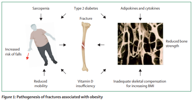 TheLancetEndo's tweet photo. #Bone health in adults with #obesity before and after interventions to promote weight loss https://t.co/hfowXJwcOw 
#osteoporosis #fractures #BMD #BariatricSurgery #GLP-1 receptor agonists https://t.co/gVRejFVQ70
