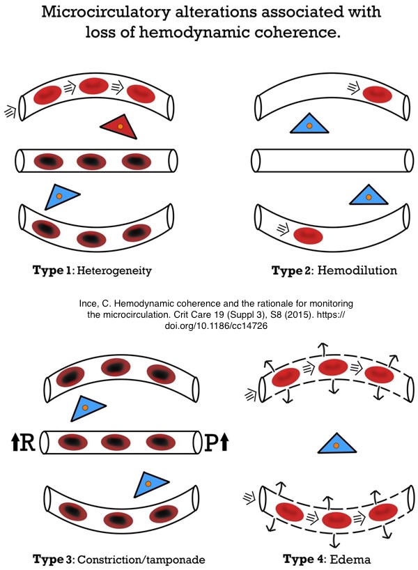There are 4 types of microcirculation abnormalities. 3 of them can be iatrogenic from injudicious fluid administration. Haemodilution, high CVP and oedema all reduce tissue perfusion. Maintaining coherence between circulatory interfaces is key. Follow those tagged for more.