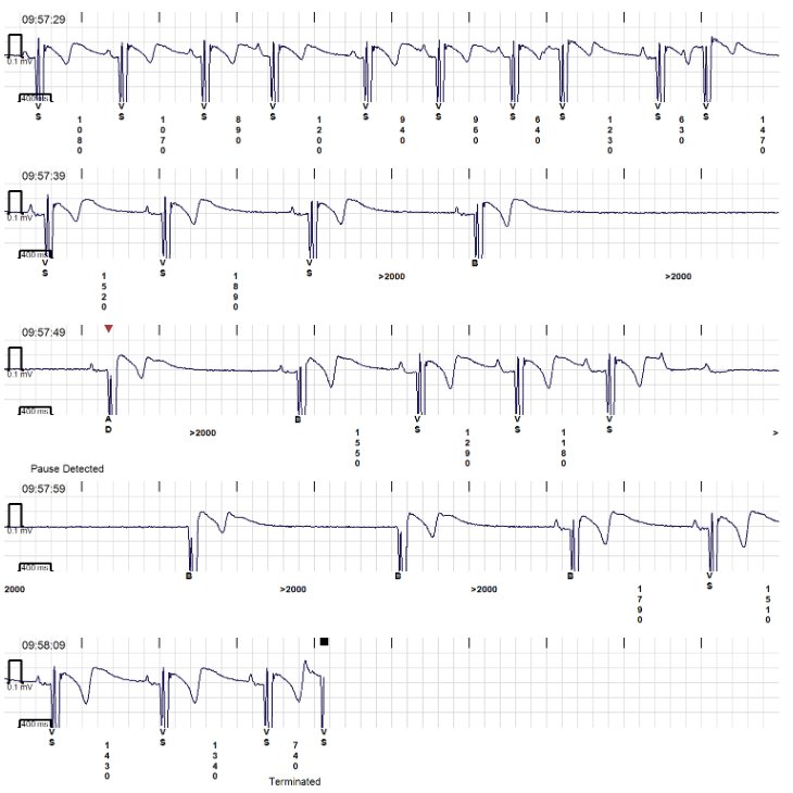 Timothy Markman (@dr_markman) on Twitter photo #EPeeps & <a href="/CardioNerds/">CardioNerds</a> - when your young patient's symptom episodes look like this, recognize vagal mechanism of simultaneous sinus rate slowing & PR prolonging. Have a discussion re #CNA before implanting a PPM - independent of the pause duration! <a href="/PennEPFellows/">Penn Electrophysiology Fellowship</a> know this well. #EPeeps & <a href="/CardioNerds/">CardioNerds</a> - when your young patient's symptom episodes look like this, recognize vagal mechanism of simultaneous sinus rate slowing & PR prolonging. Have a discussion re #CNA before implanting a PPM - independent of the pause duration! <a href="/PennEPFellows/">Penn Electrophysiology Fellowship</a> know this well.