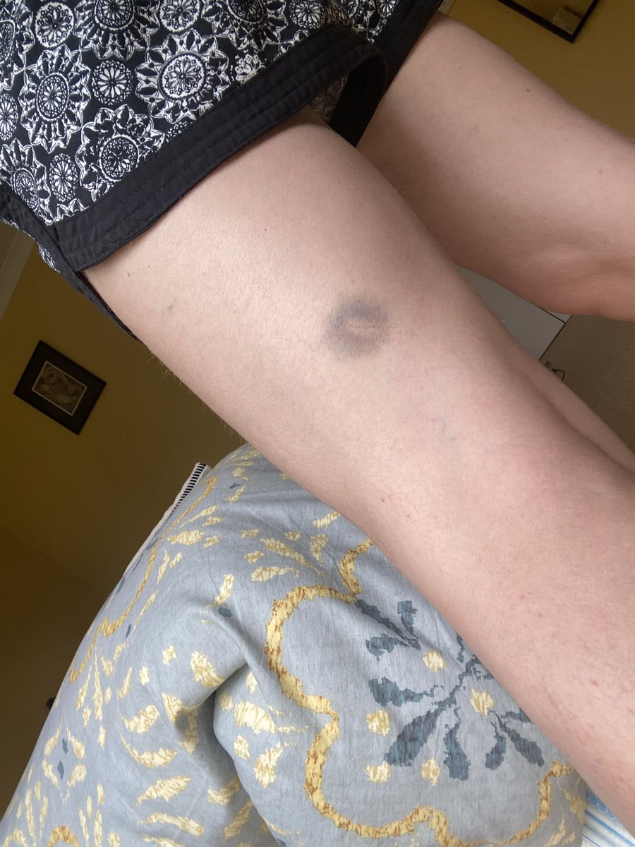 Hey pals is this Lymes disease? (The bruise, not the hairiness). Come to boardgame smackdown tomorrow at the counting house 1pm to see if it’s got better or worse xxx #EdFringe