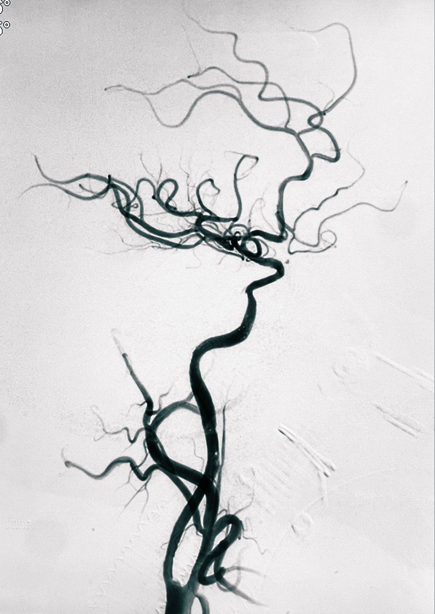 Symptomatic carotid CTO recanalization. 
1. SpiderFX serves as both a drill and an embolic protection device.
2. Angioplasty for large-bored aspiration catheter to get through.
3. The aspiration catheter functions as both thrombectomy and exploration of the carotid lumen.
4.