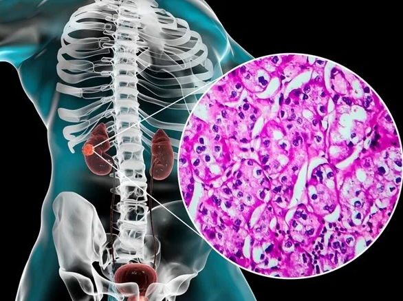 OncoDaily tweet media