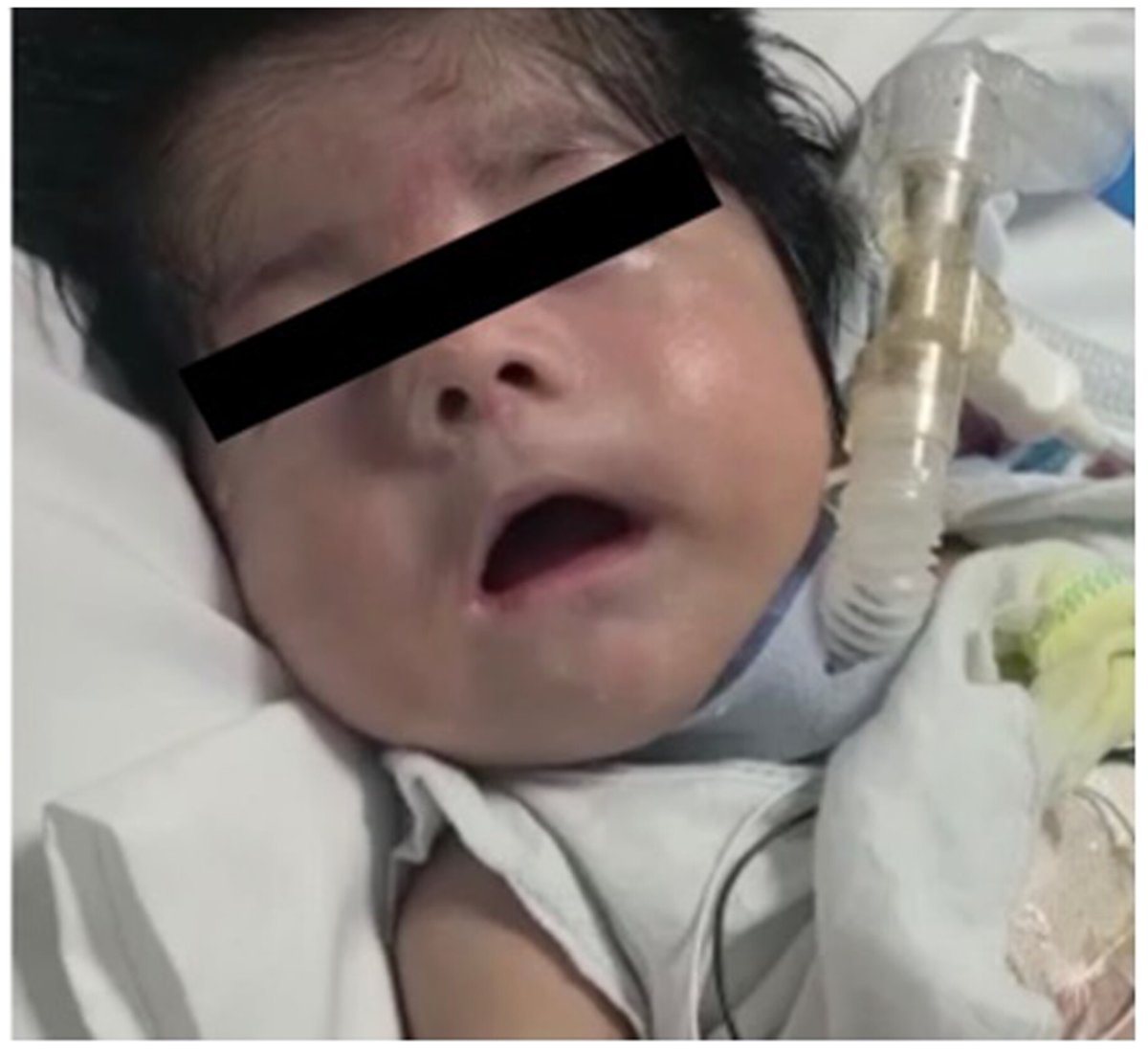 Annals of the Child Neurology Society (@annalscns) on Twitter photo Lekshmi Peringassery Sateesh & colleagues from <a href="/sunydownstate/">SUNY Downstate</a> report a novel homozygous alternate transcript mutation in the DST gene causing a severe neonatal form of hereditary sensory and autonomic #neuropathy type VI: onlinelibrary.wiley.com/doi/10.1002/cn…
@wileyneuro Lekshmi Peringassery Sateesh & colleagues from <a href="/sunydownstate/">SUNY Downstate</a> report a novel homozygous alternate transcript mutation in the DST gene causing a severe neonatal form of hereditary sensory and autonomic #neuropathy type VI: onlinelibrary.wiley.com/doi/10.1002/cn…
@wileyneuro