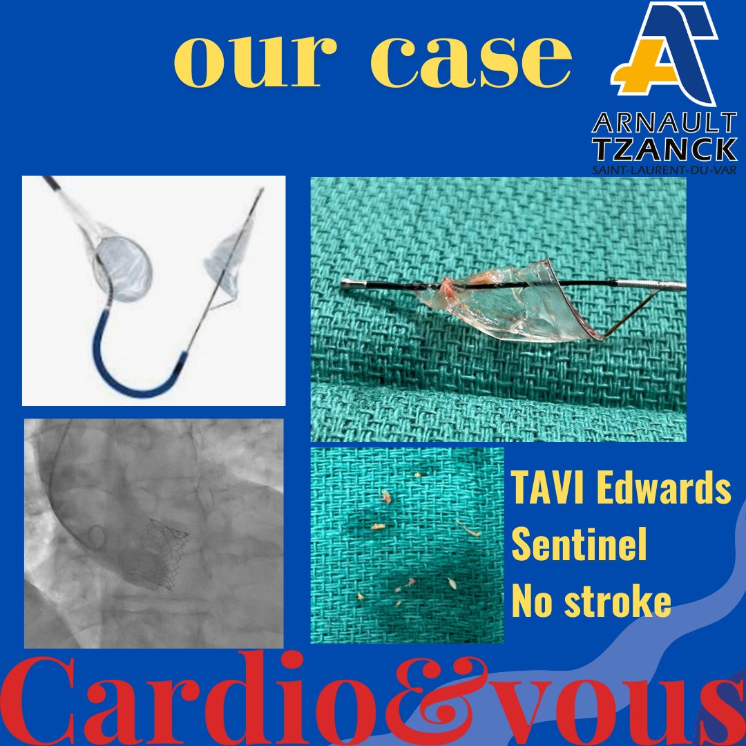 Thanks to Dr Bonnet et al. to show this increase risk of stroke with transfemoral TAVI with aortic wall thrombus. We used cerebral protection device to avoid this risk. We kept several thrombi and avoid stroke.
cardioetvous.com
cardioetvous.com/ameliorer-la-s…