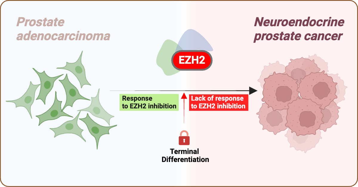 Dana-Farber News (@danafarbernews) on Twitter photo Prostate adenocarcinoma can shift to small-cell neuroendocrine #prostatecancer (NEPC) due to EZH2. <a href="/DanaFarber/">Dana-Farber</a> research in <a href="/NatureComms/">Nature Communications</a> find EZH2's role differs in these cancers—targeting it may help adenocarcinoma (cont) ms.spr.ly/l/6018lobX2 Prostate adenocarcinoma can shift to small-cell neuroendocrine #prostatecancer (NEPC) due to EZH2. <a href="/DanaFarber/">Dana-Farber</a> research in <a href="/NatureComms/">Nature Communications</a> find EZH2's role differs in these cancers—targeting it may help adenocarcinoma (cont) ms.spr.ly/l/6018lobX2